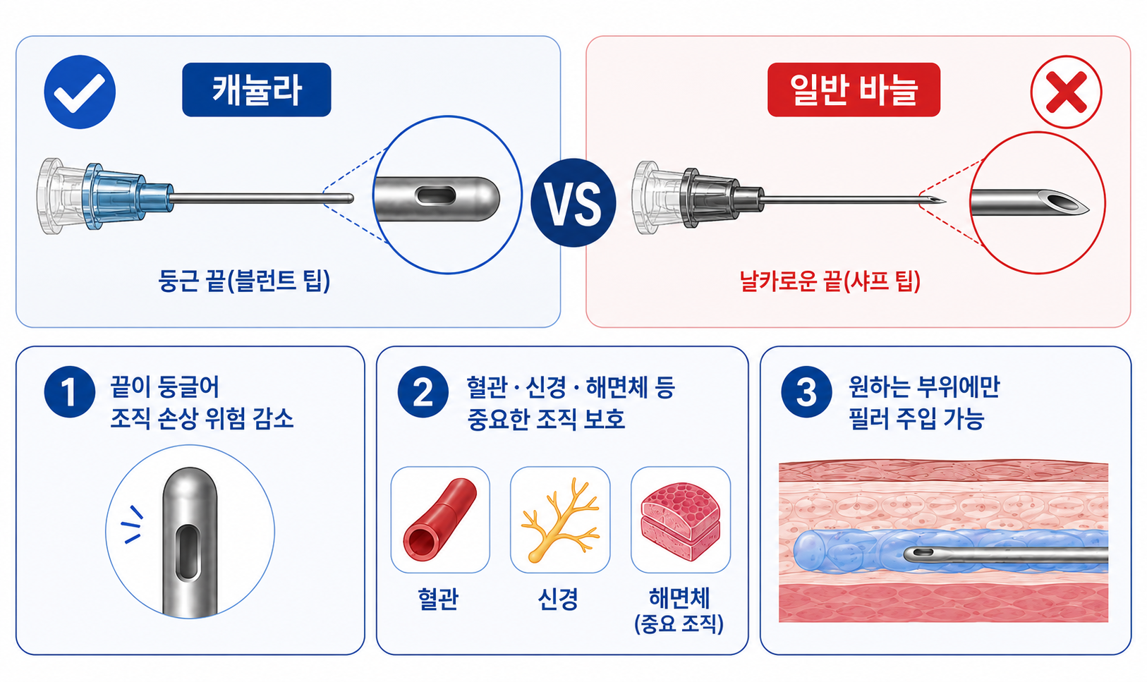 캐뉼라와 일반 바늘 비교 및 캐뉼라 사용의 세 가지 핵심 장점