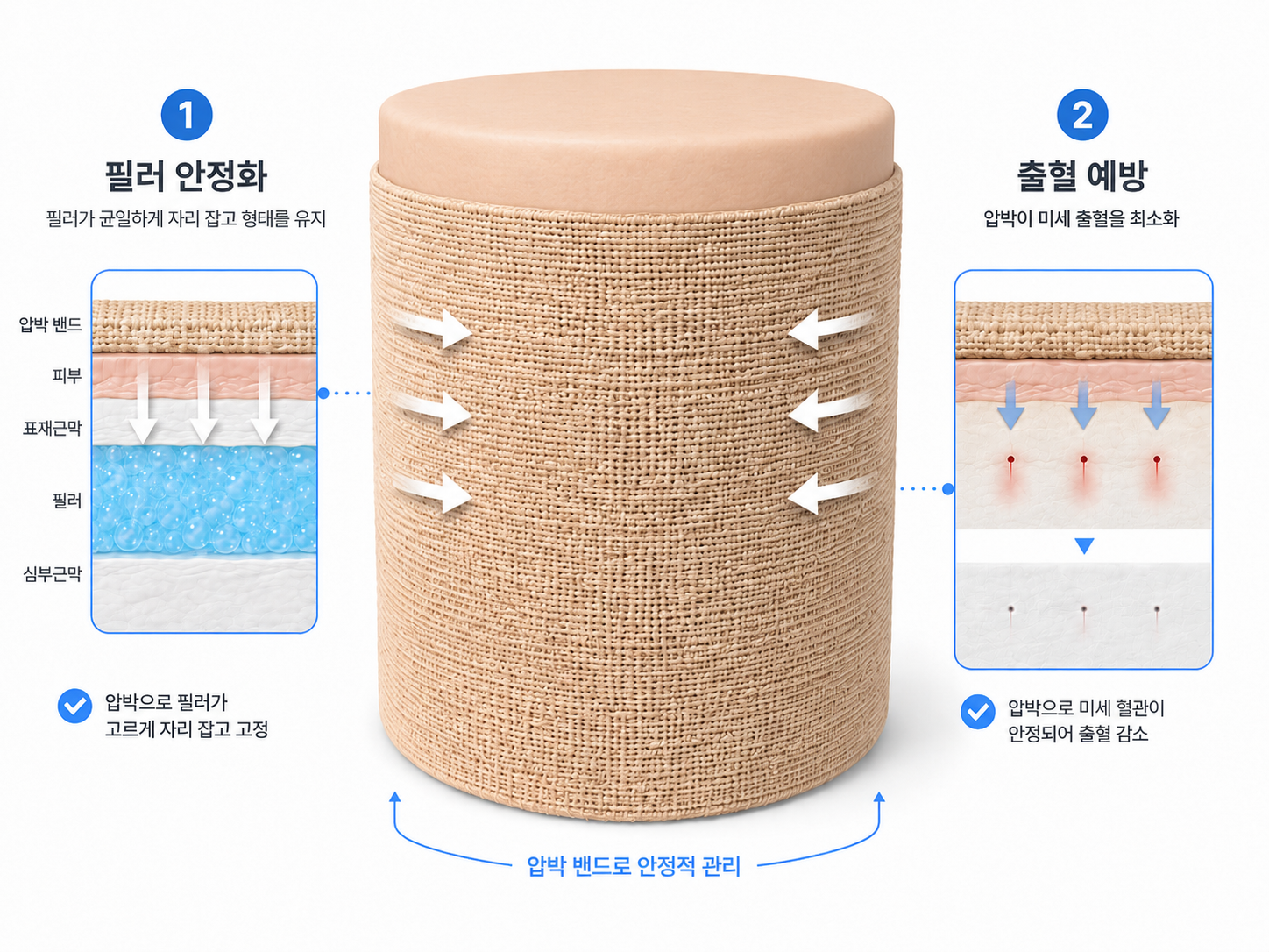 압박밴드의 필러 안정화 및 미세 출혈 예방 원리를 한눈에 설명한 이미지